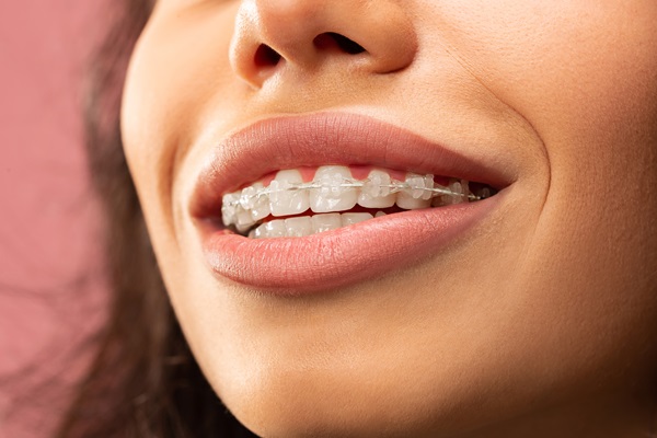 Clear Braces: Benefits And Care Tips